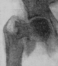 Междувертлюговый перелом правого бедра с отрывом малого вертлюга