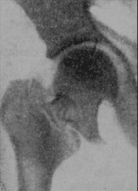 Междувертлюговый перелом шейки правого бедра со значительным смещением отломков