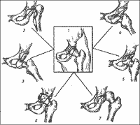 Фото Вывих тазобедренного сустава изображение